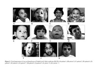 Multiple congenital anomalies/mental retardation syndrome caused by defect in cholesterol synthesis